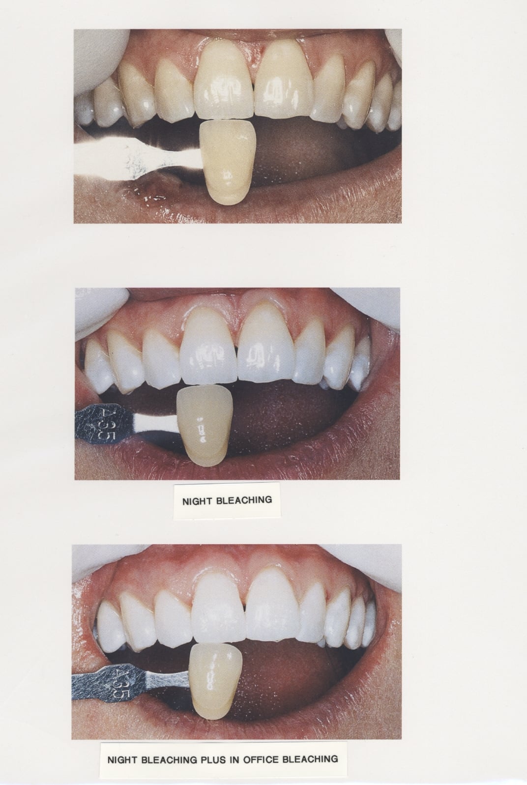 Kor Whitening System - Before and After